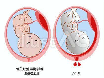 胎盤剝離後期|胎盤がはがれる、常位胎盤早期剥離について｜東京・世田谷での 